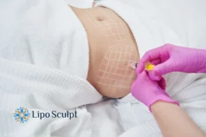 Are The Results From Aqualyx Permanent? 1 Do you want to know how long Aqualyx Wibsey results last?