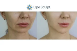Explaining Morpheus8 And What It Can Do For You 2 Do you want to boost your self confidence? Give Morpheus8 Wibsey a try today!
