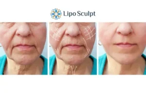 Explaining Morpheus8 And What It Can Do For You 3 Boost your confidence with Morpheus8 Wibsey call our team today!