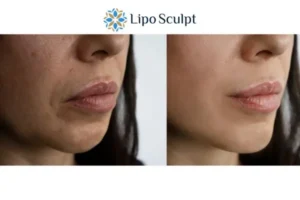 Explaining Morpheus8 And What It Can Do For You 4 Morpheus8 Wibsey the best results - call our team today!