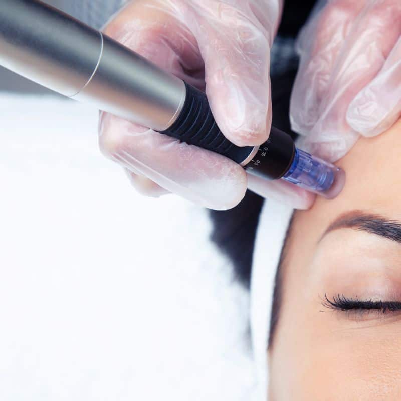 Morpheus8 treatment Wibsey from Lipo Sculpt - Book in today!