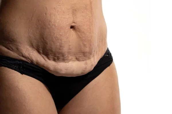 Lost the Weight but Not the Loose Skin? 1 image of womans stomach after weight loss showing loose skin Wibsey
